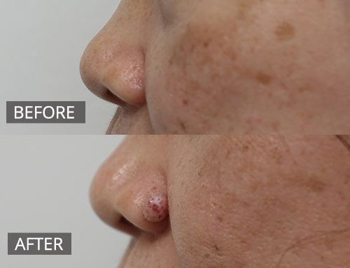 Pre and 6 weeks post Cosmetic Mole removal (RF) on nose 003 - 65