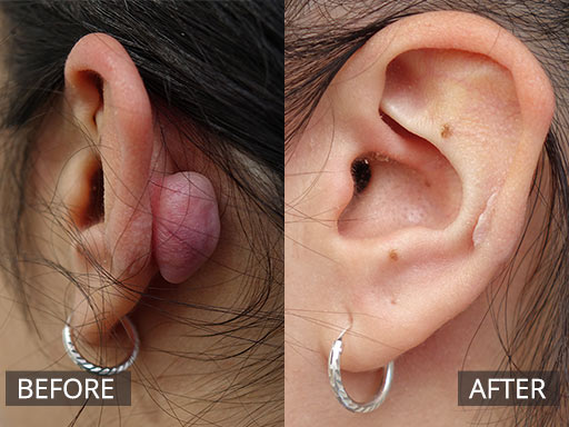 3 months Post ear keloid removal - 57