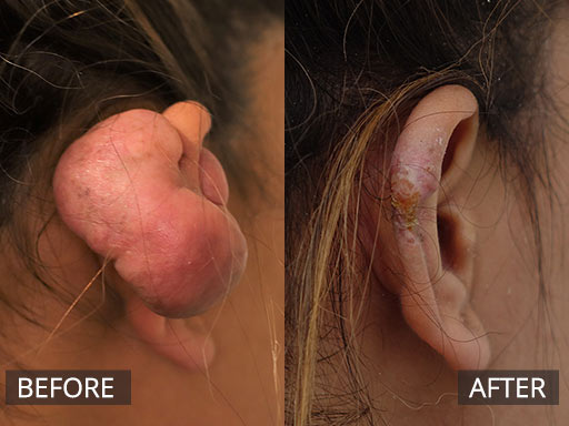 Large Ear Keloid scar removal and 3months POST_003 - 73