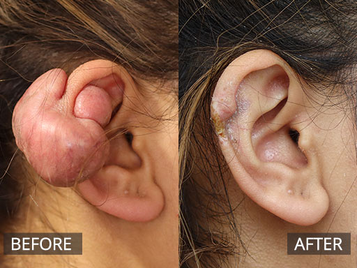 Large Ear Keloid scar removal and 3months POST_004 - 18