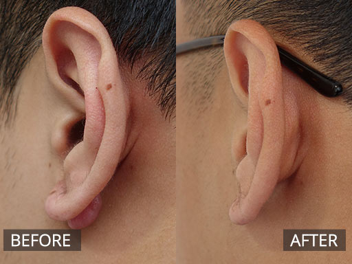 Lower ear keloid removal – 3 months POST_001 - 33