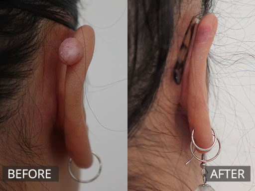 Ear keloid removal – 3 months post 002 - 79